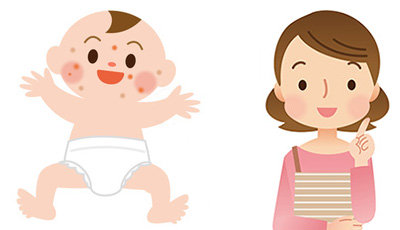 乳児湿疹の種類と対策 生後2週間ぐらいから出来るニキビみたいな湿疹