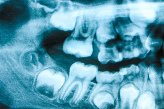 10代後半から20代前半に生えてくる人が多く、別名“18歳臼歯”と呼ばれます。 